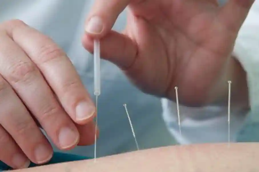 medical acupuncture on a healing retreat